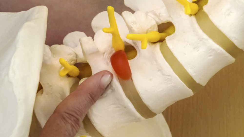 Herniated Disc Skeleton Stock Photo
